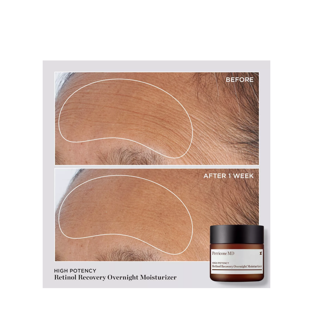Perricone MD High Potency Retinol Recovery Overnight Moisturizer 2 fl oz | Anti-Aging Retinol Night Cream