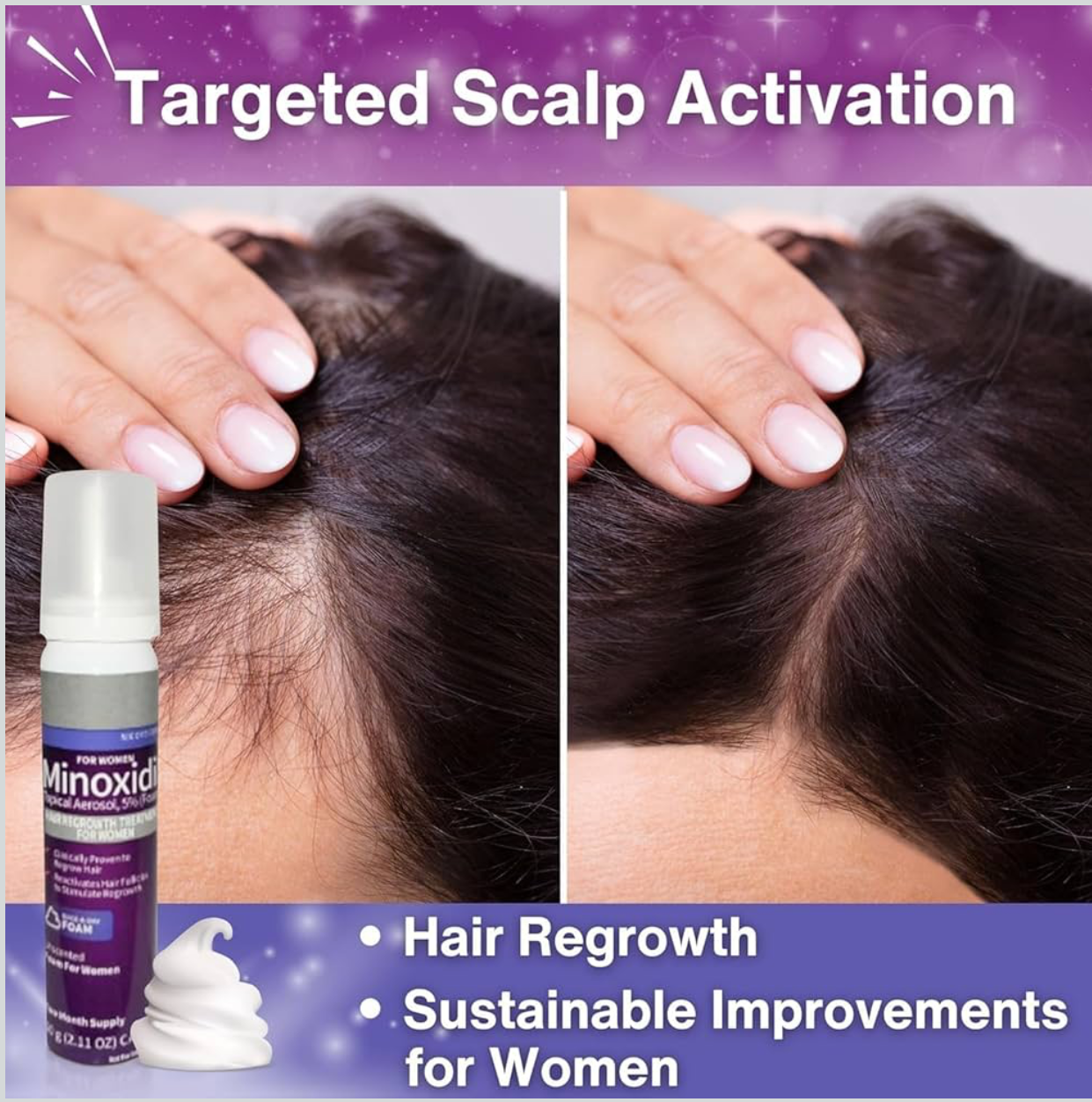 Minoxidil 5% Hair Regrowth Foam for Women – Unscented | 2-Month Supply